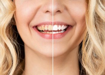 Why Teeth Whitening in Bali Can Be a Great Option