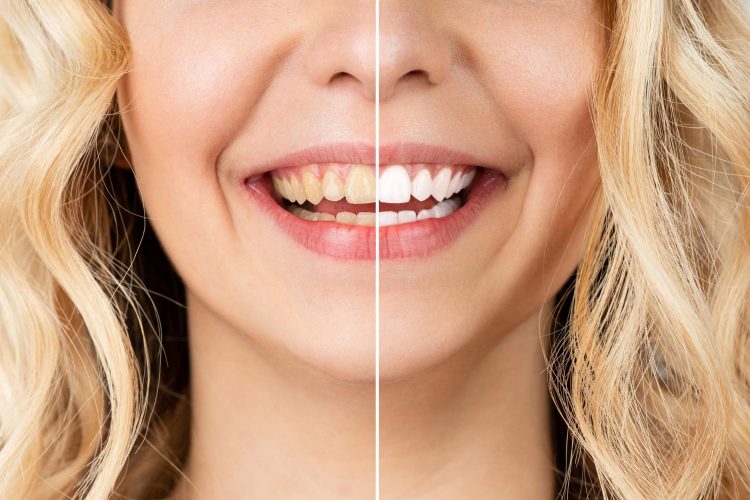 Why Teeth Whitening in Bali Can Be a Great Option