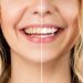 Why Teeth Whitening in Bali Can Be a Great Option
