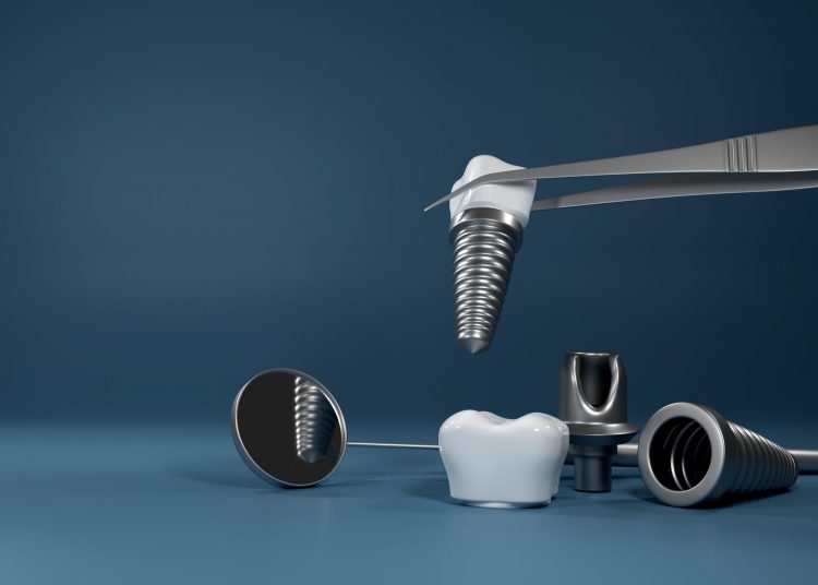 Can you get dental implants on NHS?