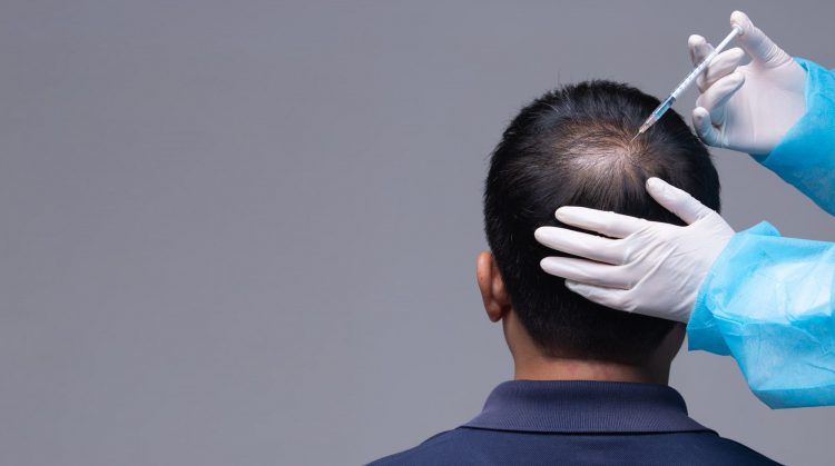 Will I continue to lose my remaining hair after my hair transplant? 