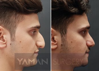 Enhancing Beauty: Exploring the Benefits of Rhinoplasty in Turkey