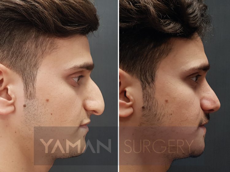 Enhancing Beauty: Exploring the Benefits of Rhinoplasty in Turkey