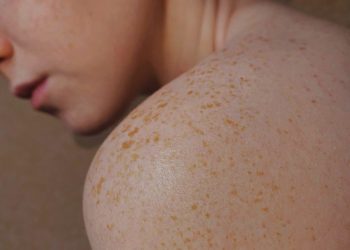 Effective Pigmentation Removal Techniques: Achieving Clear and Radiant Skin