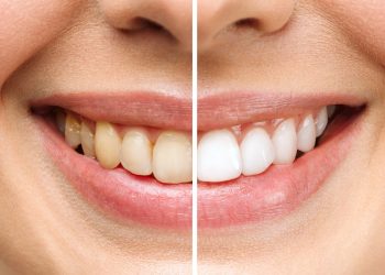 Brighten Your Smile: Exploring Teeth Whitening ProductsIntroduction