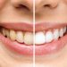 Brighten Your Smile: Exploring Teeth Whitening ProductsIntroduction