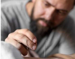 Men and Needles: Acupuncture’s Surprising Benefits for the Modern Man