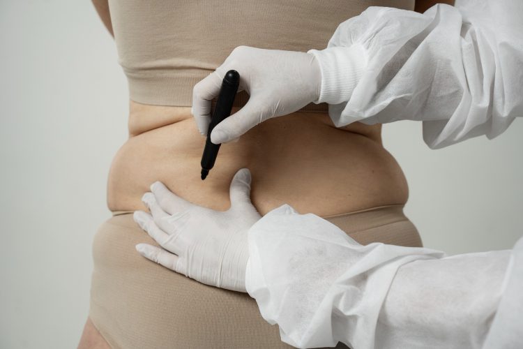 CoolSculpting in Melbourne: The Revolutionary Non-Surgical Fat Reduction Treatment