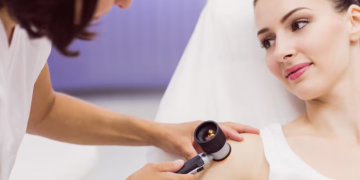 Why Do People Choose Mole Removal? Understanding the Reasons Behind Treatment