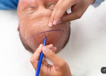 Sapphire FUE Explained: What Sapphire Blades Change in a Hair Transplant