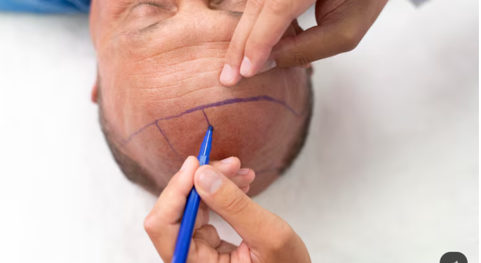 Sapphire FUE Explained: What Sapphire Blades Change in a Hair Transplant