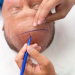 Sapphire FUE Explained: What Sapphire Blades Change in a Hair Transplant